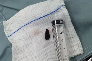 Hạt sa pô chê nằm trong phế quản bệnh nhân 27 năm