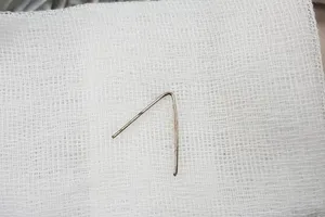 Đang chơi thì nuốt đoạn kim loại, bé 5 tuổi vào viện cấp cứu