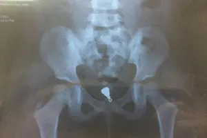 Gắp mặt dây chuyền nằm sâu trong âm đạo bé gái 5 tuổi