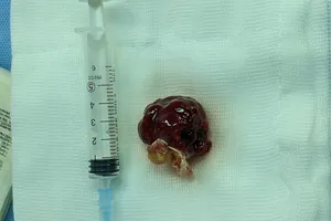 4 giờ phẫu thuật cứu người phụ nữ mang khối u trong tim