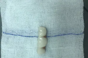 Ăn cơm, cụ bà nuốt luôn 4 răng giả mới lắp