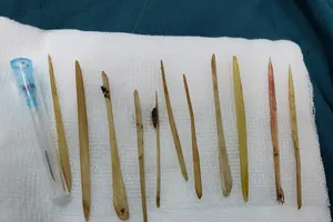 11 cây tăm trong bụng người đàn ông thích ngậm tăm khi ngủ