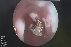 Ngủ dậy, phát hiện hàm răng giả đã 'chui tọt' vào phế quản