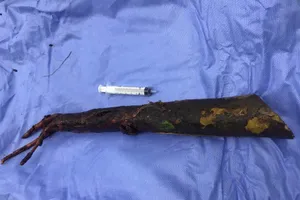 Người đàn ông bị cọc bần dài 80 cm đâm xuyên hạ vị 