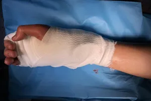 Nối bàn tay bị chém đứt lìa không cần chỉ khâu cho thiếu niên 17 tuổi