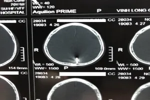 Trầm cảm thời gian dài, cụ ông 70 tuổi tự đóng đinh vào đầu