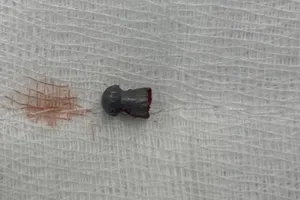 Đang làm lúa ngoài đồng, bất ngờ bị đạn lạc xuyên vùng kín