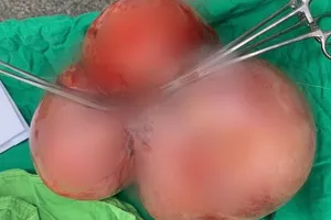 Phẫu thuật lấy khối u khủng nặng 5,5kg nằm trong tử cung phụ nữ