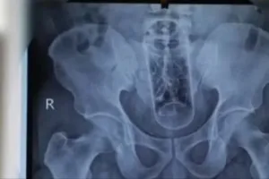 Phẫu thuật cấp cứu lấy chai nhựa dài 20cm trong hậu môn người đàn ông