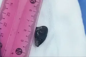 Hạt hồng xiêm bị bỏ quên hơn 10 năm trong phế quản