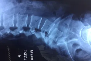 Phẫu thuật cột sống cho bệnh nhân nước ngoài