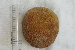 Phẫu thuật lấy viên sỏi bàng quang kích thước 'khủng'