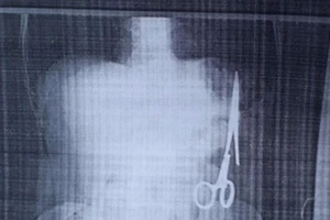 Mổ lấy panh bị 'bỏ quên' 18,5 năm trong bụng bệnh nhân