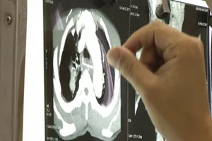 Hi hữu: Cụ ông nguy kịch vì bị xương gà đâm thấu tim