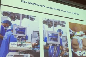 Ghép gan cứu sống bệnh nhân đã tiên lượng 90% tử vong