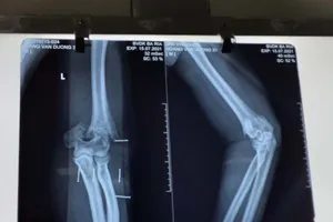 3 giờ phẫu thuật nối cánh tay cho Thượng úy Hoàng Văn Dương 