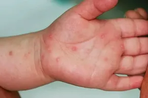 TP.HCM cảnh báo tác nhân EV71 gây bệnh tay chân miệng nặng xuất hiện trở lại