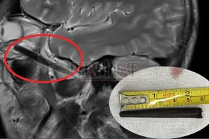 Chuyện lạ: Bị chiếc đũa đâm sâu trong hốc mắt mà không biết
