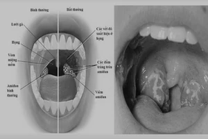 Sau khi cắt amidan có được ăn kem, uống nước ngọt?