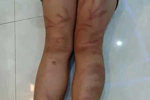 Nhóm học sinh mầm non bị đánh bầm tím, 2 em phải nhập viện