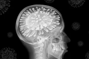 Chứng sương mù não: Virus SARS-CoV-2 đã làm gì với não bộ bệnh nhân COVID-19?