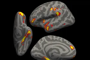 ĐH Oxford: COVID-19 khiến não co lại, giảm chất xám ở nhiều vùng quan trọng