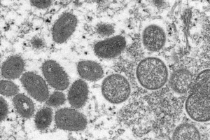 Mỹ có 2 chủng đậu mùa khỉ, CDC đề nghị xét nghiệm người nghi nhiễm để cách ly