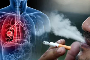 7 yếu tố làm tăng nguy cơ mắc bệnh phổi