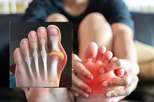 Dấu hiệu cảnh báo sớm của tình trạng axit uric cao mà bạn không nên bỏ qua