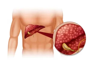 Các yếu tố giúp giảm nguy cơ mắc bệnh gan nhiễm mỡ