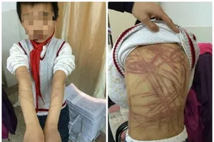 Đánh con nuôi dã man vì không hoàn thành bài tập