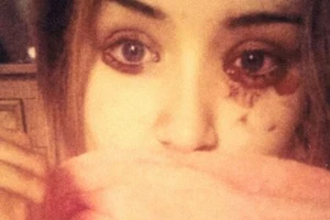 Cô gái mắc bệnh lạ, chảy… huyết lệ năm lần một ngày