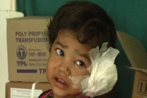 Nhặng xanh làm tổ đẻ 80 trứng trong tai bé gái 4 tuổi