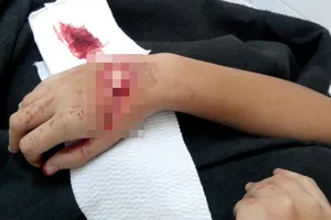 Đạp xe đi học, nữ sinh lớp 8 bị chém đứt gân tay