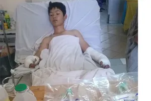 Thả diều bị điện giật, cháy xém hạ bộ