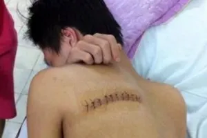 Nam sinh bị côn đồ chém rách lưng trước cổng nhà