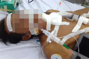 Thủng thực quản vì dùng đũa đẩy nem mắc nghẹn