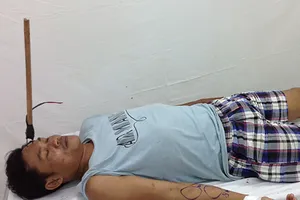 Cứu sống một người bị chỉa ghim vào sọ