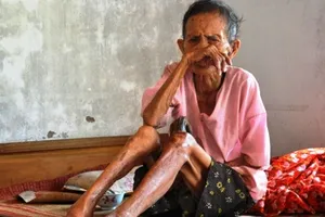 Cụ bà 97 tuổi và chiếc sừng dài 20cm giữa đầu gối