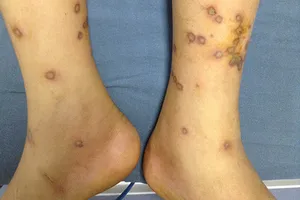 Cứu sống trẻ bị ong vò vẽ đốt gần 170 mũi