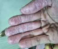 Tăng cường phòng chống viêm da sừng bàn tay, bàn chân