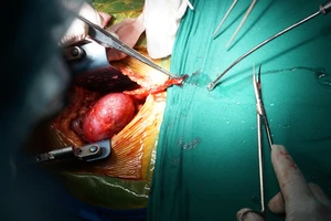 Phẫu thuật ghép thận cho bệnh nhân bị suy thận giai đoạn cuối