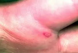 Hi hữu một người lớn mắc tay-chân-miệng