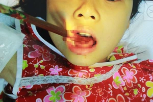 Hi hữu bé gái bị đôi đũa đâm thủng lưỡi