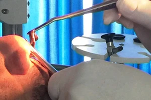 Gắp con đỉa dài 10 cm ra khỏi mũi