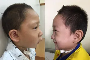 Trả lại gương mặt bình thường cho trẻ bị tật 