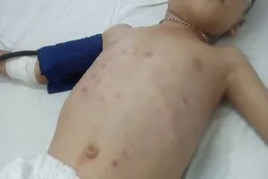 Bé 5 tuổi bị người tình của mẹ đánh nhập viện