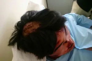 Học sinh lớp 11 nhập viện cấp cứu vì bị nhóm bạn đánh