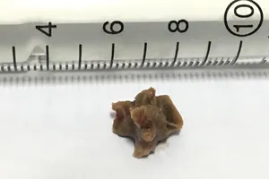 Mảnh xương hình khối nằm trong phế quản bệnh nhân suốt 5 năm