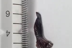 Lấy dị vật bị bỏ quên trong phế quản suốt 10 năm